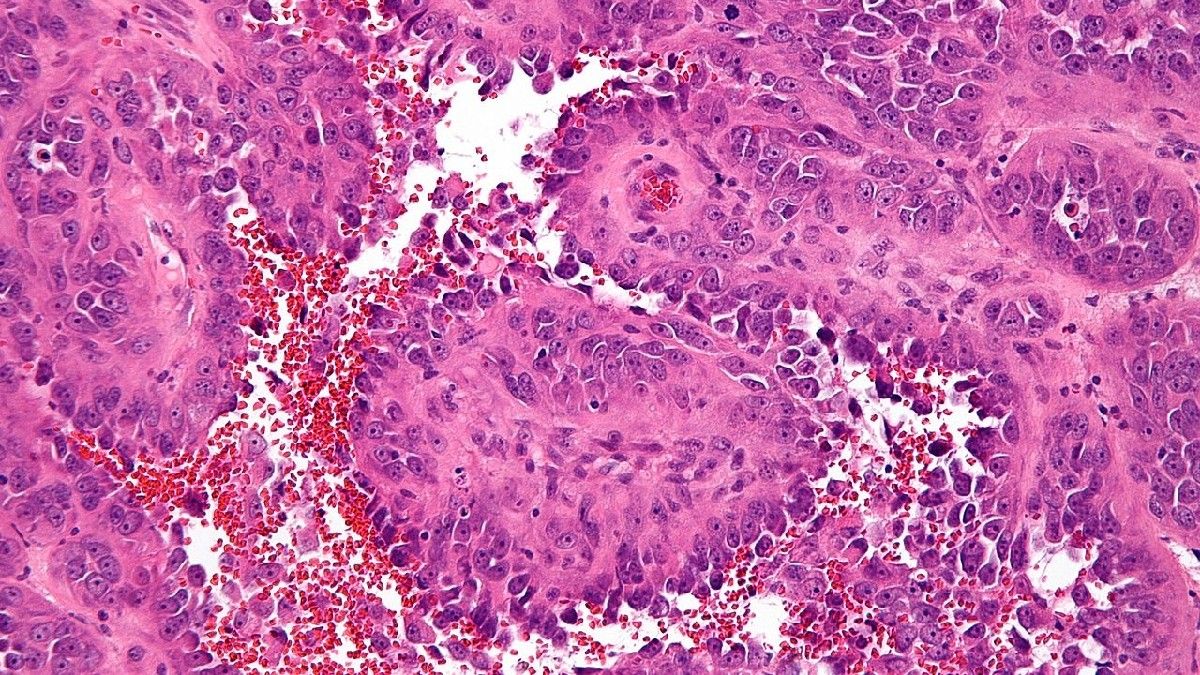 Mengenal Faktor Risiko Penyebab Kanker Angiosarkoma