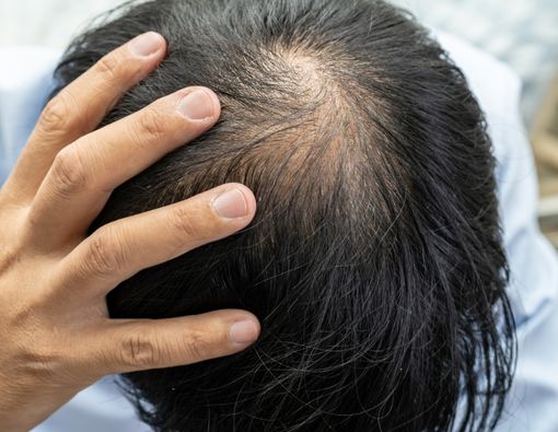 13 Cara Ampuh Mengatasi Rambut Rontok yang Bisa Kamu Coba