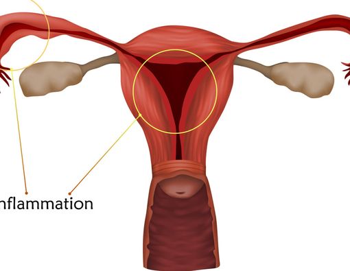 Kenali Lebih Dekat Penyakit Radang Panggul pada Wanita
