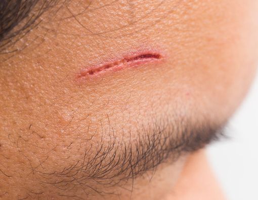 Kiat Menghilangkan Bekas Luka di Wajah