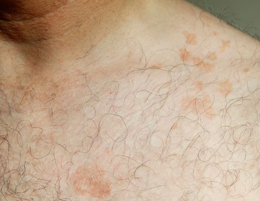 Jangan Keliru, Kenali Ciri-Ciri Panu yang Terlihat Jelas di Kulit