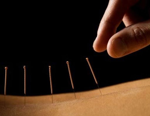 Chiropractic Vs Akupunktur: Mana yang Lebih Baik?