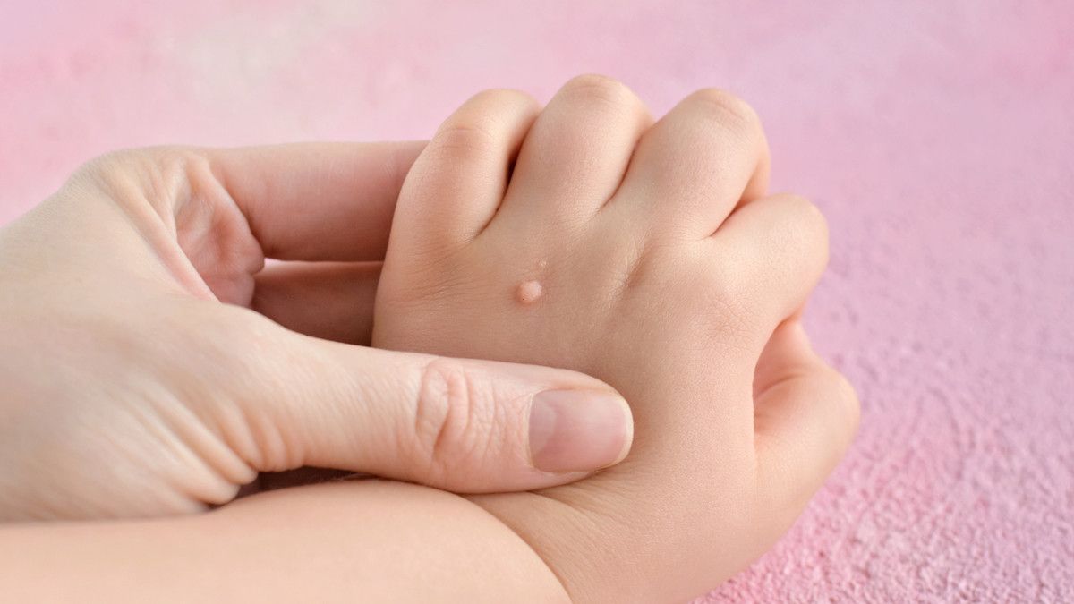 Penyebab dan Cara Mengatasi Kutil di Tubuh Anak