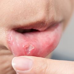 11 Rekomendasi Obat Sariawan Terbaik di Apotek