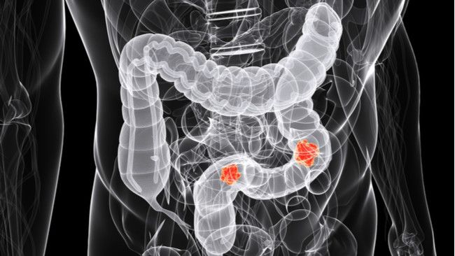 Waspadai 5 Gejala Kanker Kolon Ini (Sebastian-Kaulitzki/Shutterstockjpg)