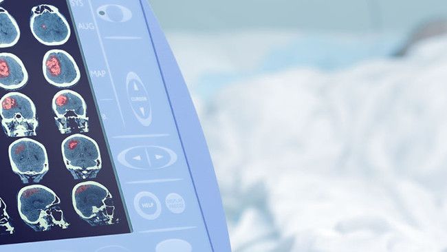 Mengenali Ciri-ciri Kondisi Mati Otak