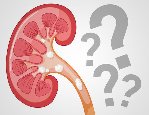 Mengungkap Fakta di Balik Batu Ginjal Berulang