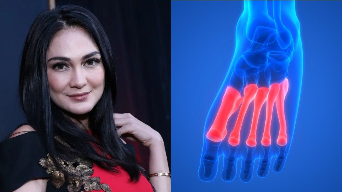 Ini Bahaya Cedera Tulang Metatarsal Seperti yang Dialami Luna Maya