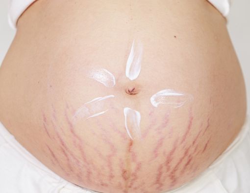 Bisakah Stretch Mark Hilang Total?