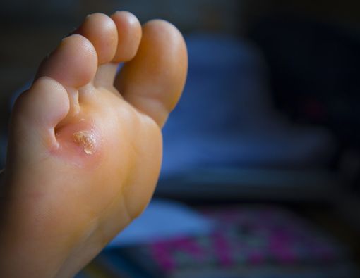 Tips Mudah Mengatasi Mata Ikan di Kaki