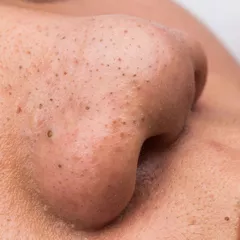 15 Cara Menghilangkan Komedo dengan Bahan Alami