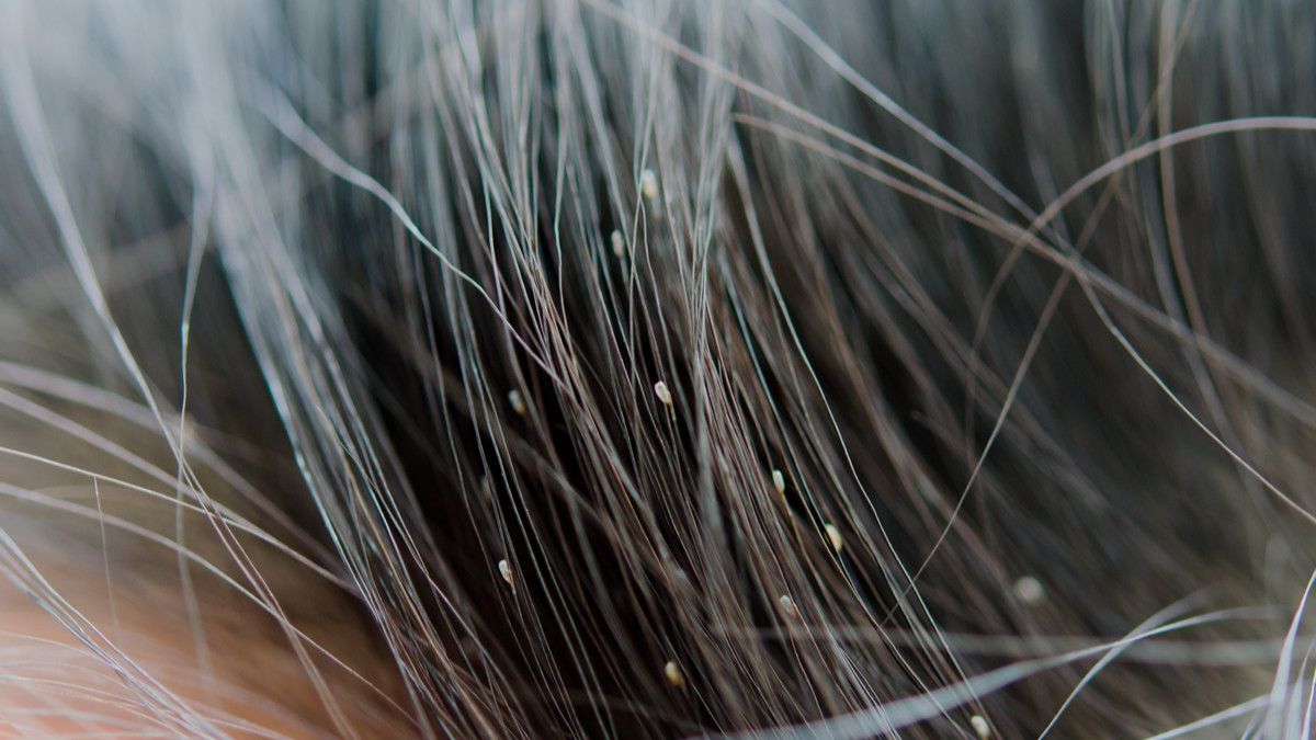 Amankah Basmi Kutu Rambut dengan Minyak Kayu Putih?