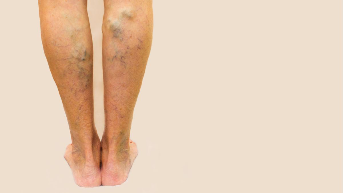 Cara Alami Mengatasi Varises