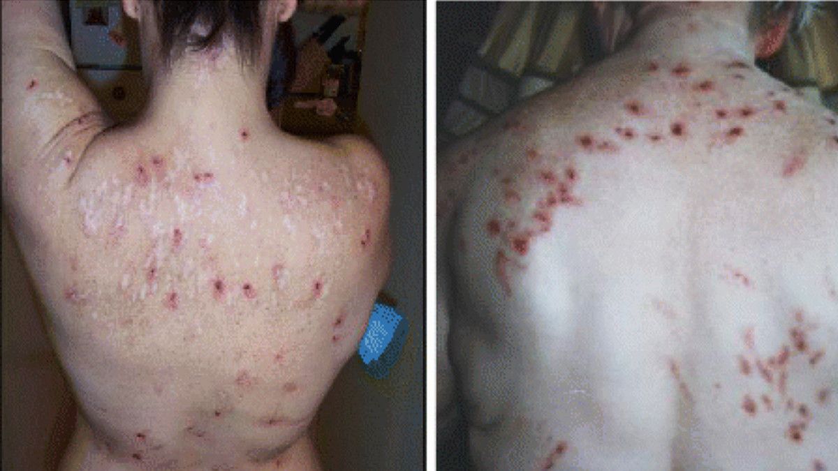 Morgellons