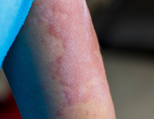 Waspada, Anak dan Bayi juga Dapat Terkena Sifilis