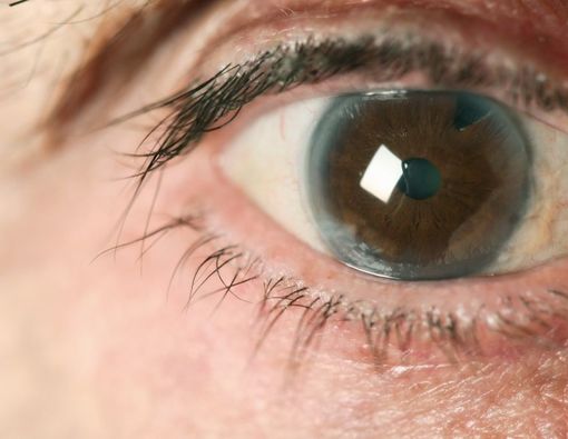 Cara Mencegah Kebutaan Akibat Glaukoma