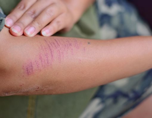 5 Penyebab Tubuh Anda Mudah Memar