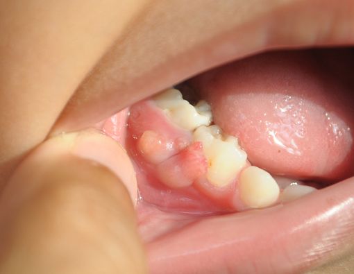 Gum Boil, Ketika Gusi Bengkak dan Bernanah