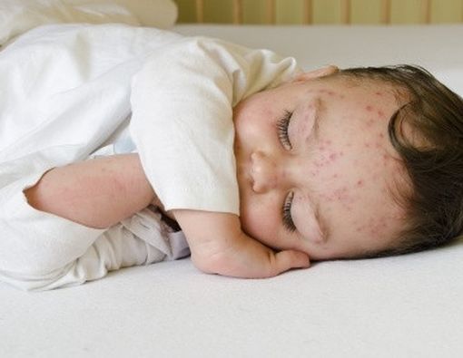 Waspada Ruam Popok Bayi!