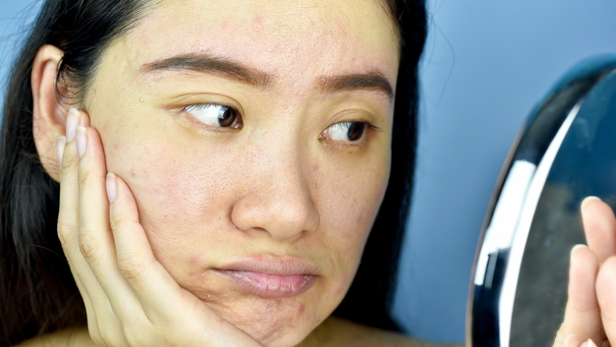 Tanda-Tanda Wajah Rusak Karena Merkuri