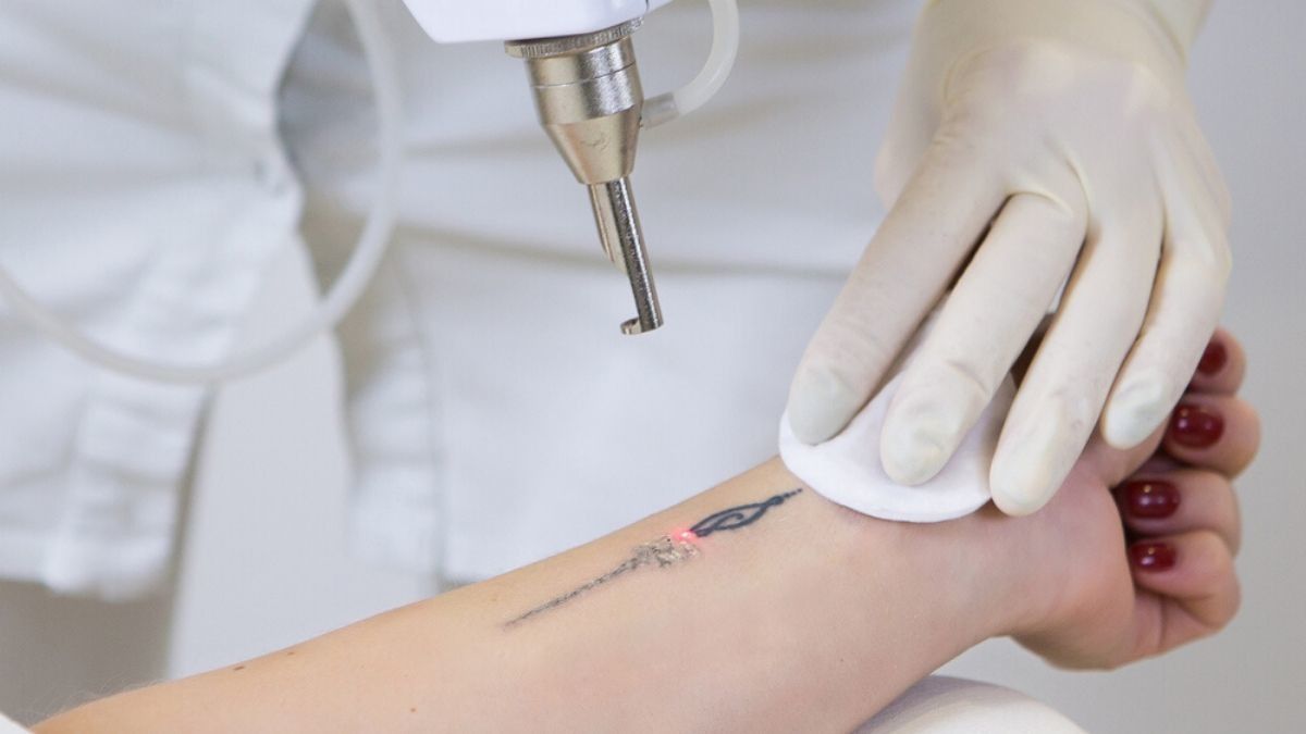 Ingin Menghilangkan Tato dengan Laser? Ketahui 7 Fakta Ini Dulu - KlikDokter