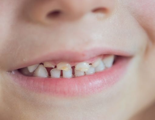Ketahui, Ini Perbedaan Gigi Susu dan Gigi Permanen