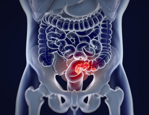Bahaya Kanker Usus yang Menyebar Hingga ke Rahim
