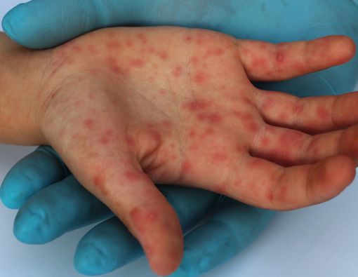 Mengenal Penyakit Kawasaki Lebih Dekat