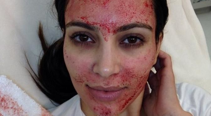 Benarkah Facial Vampir seperti Kim Kardashian Bisa Tularkan HIV?