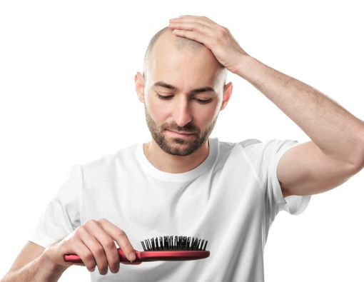 Penyebab Kebotakan di Usia Muda dan Solusinya