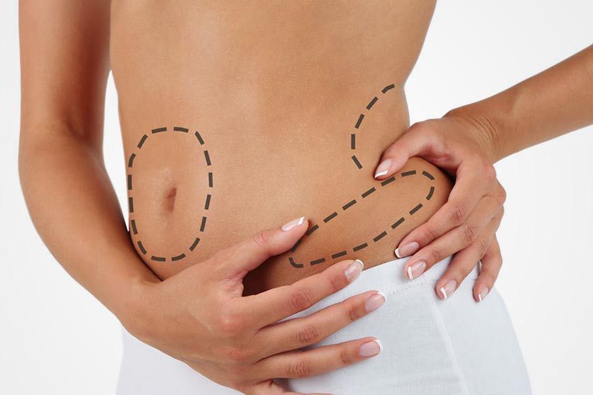 Langsing dengan Sedot Lemak,  Yakin Aman?