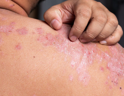 Cara Mengatasi Darah Manis atau Prurigo