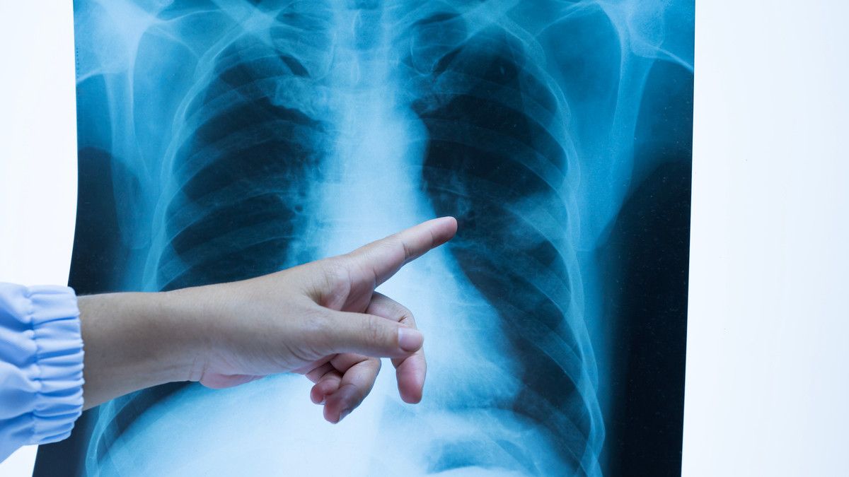Penyebab Tuberkulosis Kelenjar, Penyakit yang Sering Sembunyi