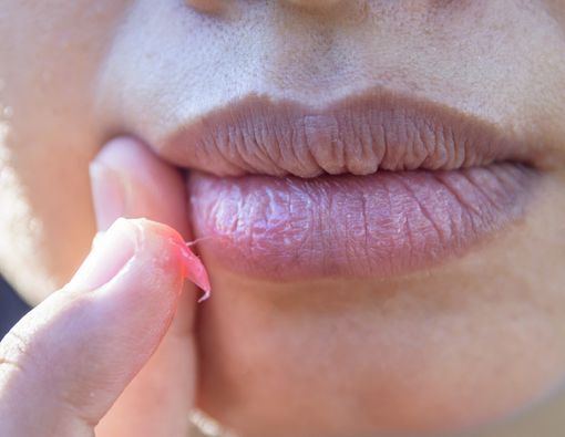 Cara Alami Mengatasi Mulut Kering