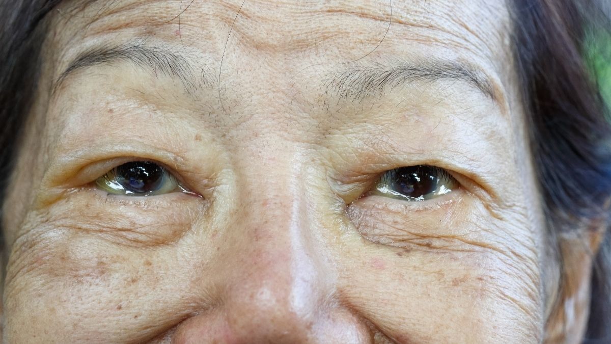 Edema Makula Diabetik, Gangguan Mata pada Penderita Diabetes