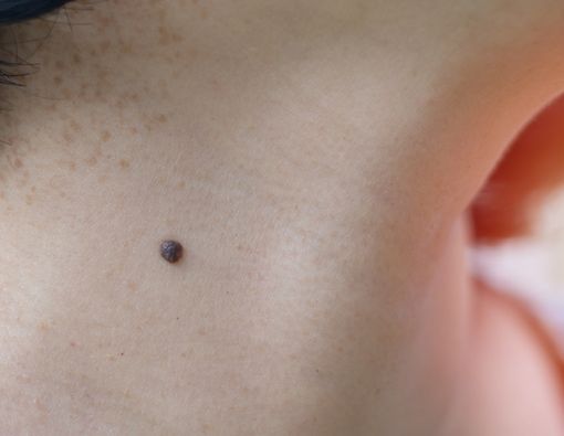 Pemilik Tahi Lalat, Waspadai Hal Ini!