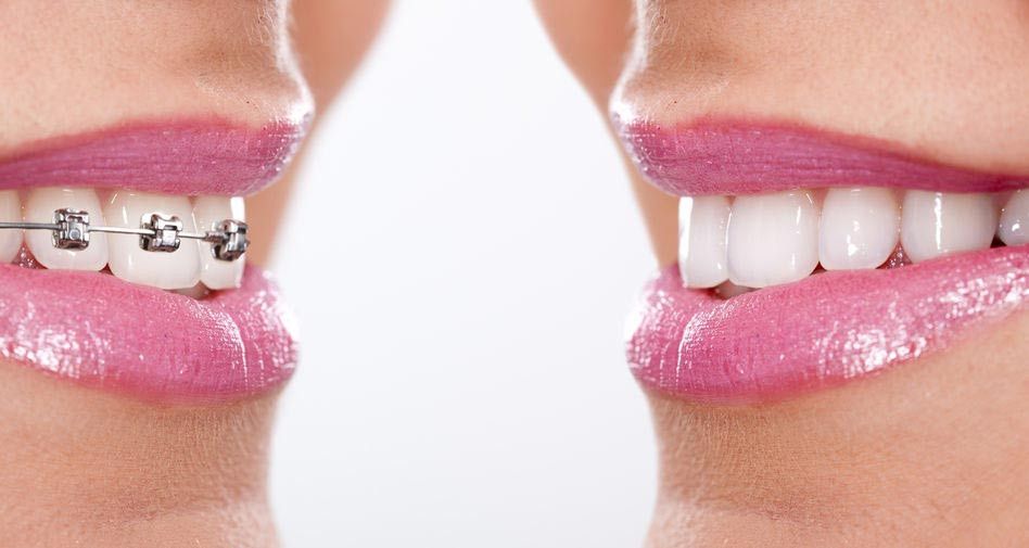 Haruskah Cabut Gigi Sebelum Pasang Behel?