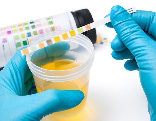 Benarkah Tes Urine Bisa Bantu Diagnosis Kanker Prostat?