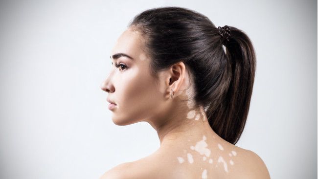 Vitiligo, Bisakah Sembuh?