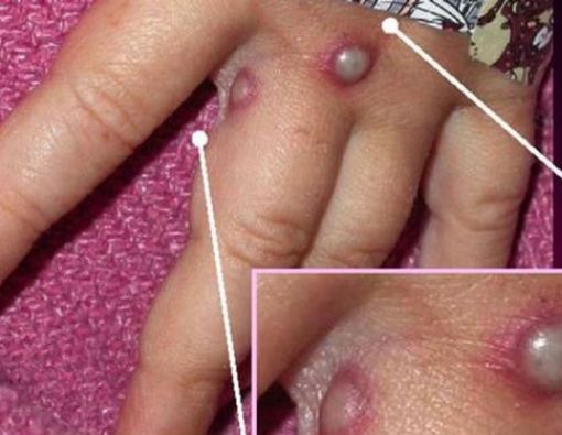 Cacar Monyet Bisa Sebabkan Kematian?