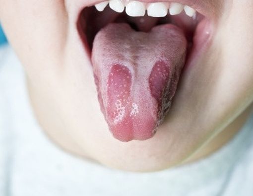 Beberapa Kelainan Lidah yang Biasa Terjadi