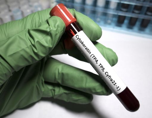 Mengenal Istilah Karsinogenik, Sang Potensi Penyebab Kanker