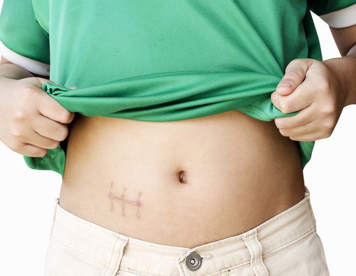 Waspadai Efek Samping Ini Usai Operasi Usus Buntu
