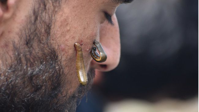 Efektikah Minyak Lintah untuk Menghilangkan Jerawat Secara Alami?