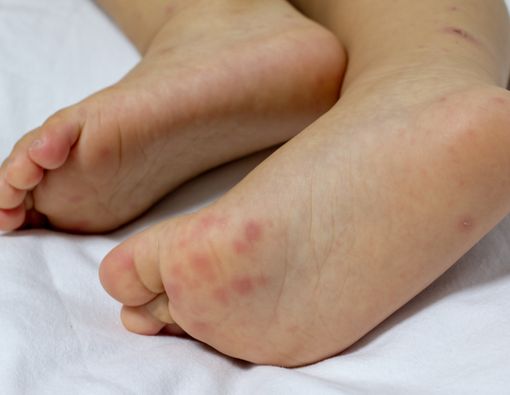 Flu Singapura pada Bayi