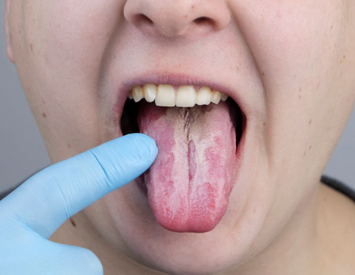 Kelainan Lidah yang Perlu Anda Waspadai