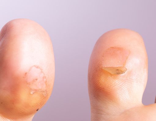 Kiat Atasi Kulit Melepuh bagi Jemaah Haji