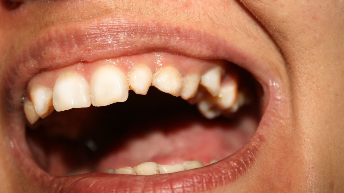 Bisakah Membuat Gigi Gingsul Secara Alami?