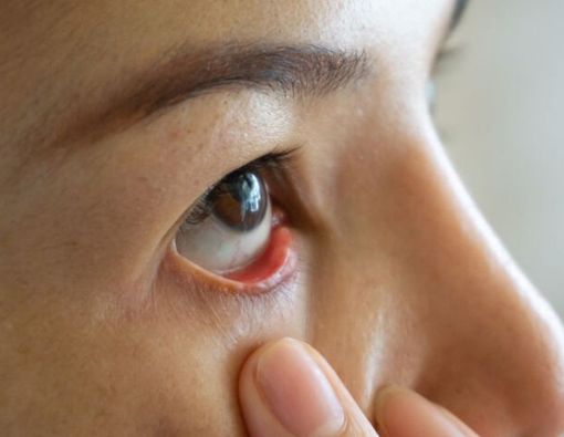 Cara Mudah Mengatasi Mata Kering