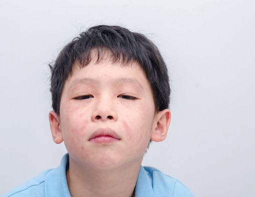 Jenis Alergi Berdasarkan Tingkat Keparahan